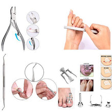 Load image into Gallery viewer, 4 in 1 Ingrown Toe Nail Corrector Tool Kit
